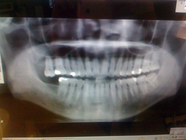 看我的牙齒有亮亮的，全是給一個用銀粉的牙醫捕的，真難看，改天要全把它換下來